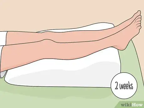 Image titled Diagnose and Treat a Tibial Plateau Fracture Step 11