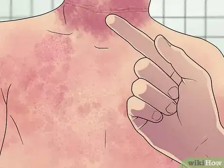 Image titled Recognize and Treat Scarlet Fever Step 2