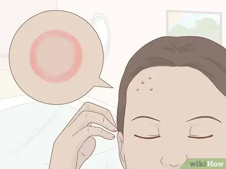 Image titled Prevent Molluscum (Molluscum Contagiosum) Step 8