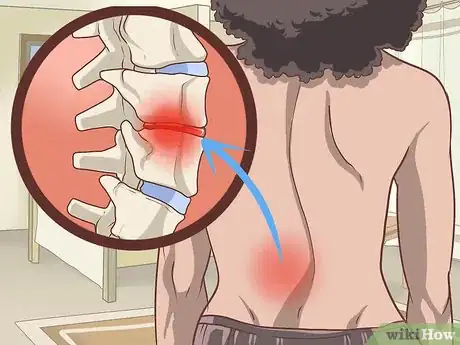Image titled Diagnose Adult Scoliosis Step 10