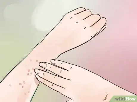 Image titled Reduce Lymphoma Risk with Psoriasis Step 2