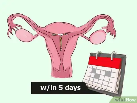 Image titled Switch Birth Control Methods Step 5