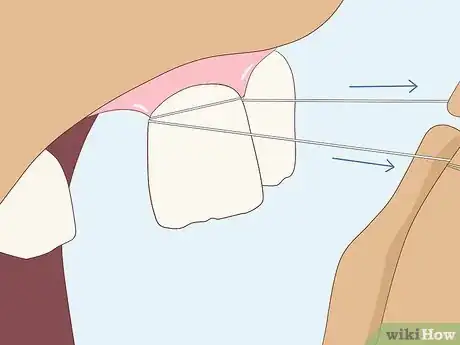 Image titled Pull a Loose Tooth at Home Step 9