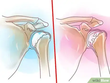 Image titled Know if Left Arm Pain Is Heart Related Step 11