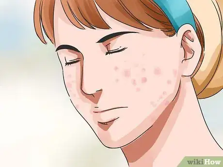 Image titled Balance Hormones for Acne Step 8