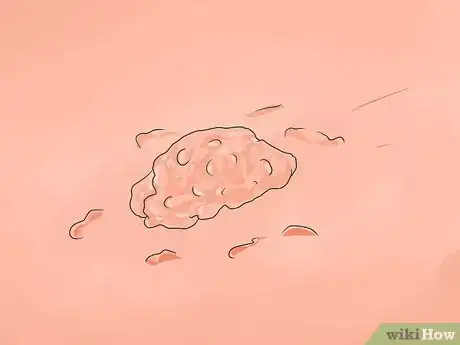 Image titled Get Rid of Genital Warts Step 2