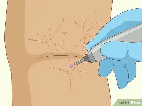 Image titled Remove Spider Veins Step 2