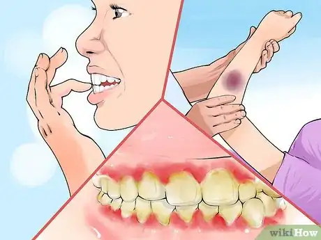 Image titled Diagnose and Treat Scurvy Step 2