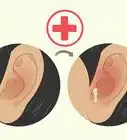 Heal a Ruptured Eardrum