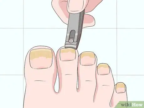 Image titled Treat Toe Nail Fungus Step 1