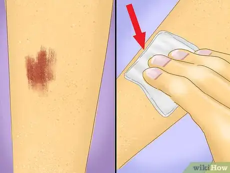 Image titled Care for Minor Abrasions and Scratches Step 2