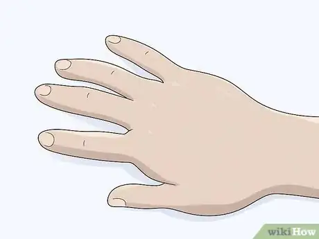 Image titled Identify Lymphedema Step 1