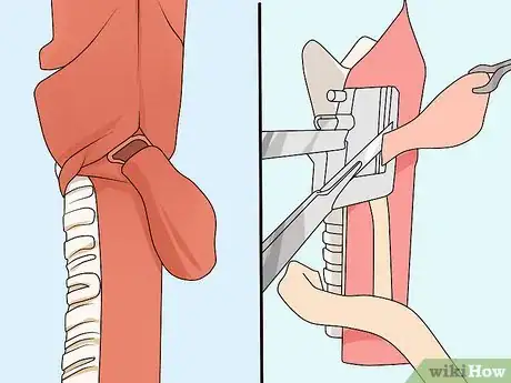 Image titled Diagnose Esophageal Diverticulum Step 13