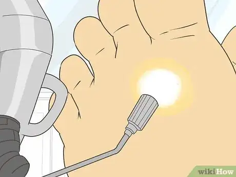 Image titled Freeze Plantar Warts Step 14