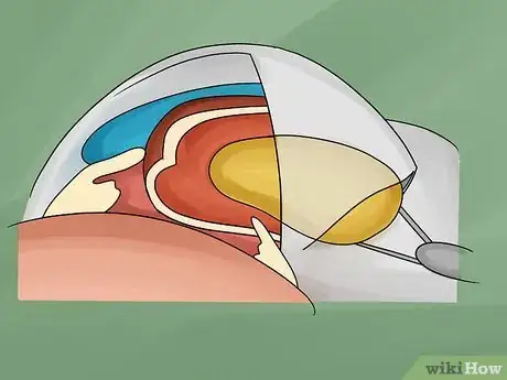 Image titled Treat Cataracts with Surgery Step 3