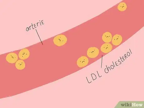 Image titled Understand the Difference Between HDL and LDL Cholesterol Step 2