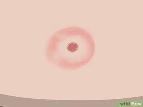 Image titled Prevent Lyme Disease Step 14