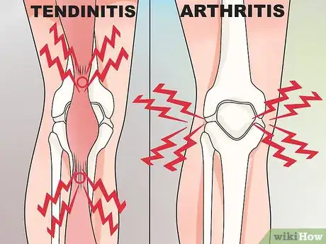 Image titled Alleviate Tendonitis Step 14