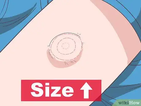 Image titled Diagnose Sarcoma Step 2