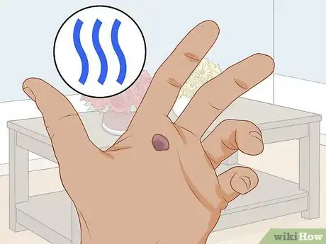 Image titled Treat a Blood Blister Step 4