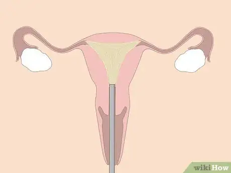 Image titled Treat Menorrhagia Step 10