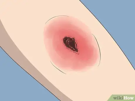 Image titled Know if a Wound Is Healing Step 8
