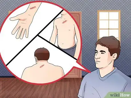 Image titled Prevent Keloid and Hypertrophic Scars Step 1