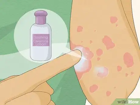 Image titled Recognize Hives (Rash) Step 11