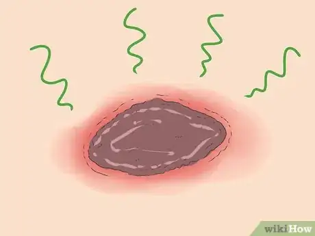 Image titled Know if a Wound Is Healing Step 4