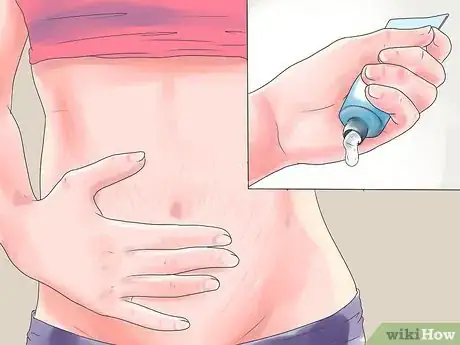Image titled Get Rid of Stretch Marks Step 2