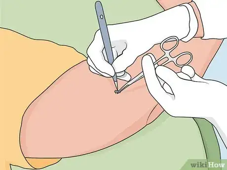 Image titled Remove Nexplanon Step 9