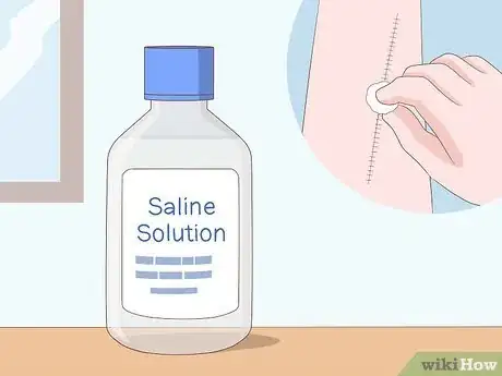 Image titled Prevent Surgical Site Infections Step 10