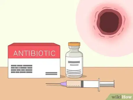 Image titled Prevent Surgical Site Infections Step 15