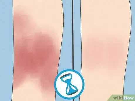 Image titled Improve Eczema with Diet Step 11