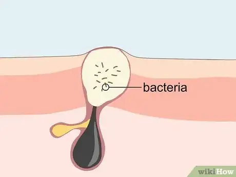 Image titled Treat Adult Acne Step 3