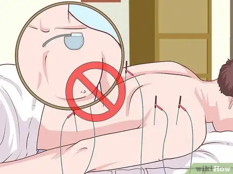 Image titled Treat Fibromyalgia with Acupuncture Step 2