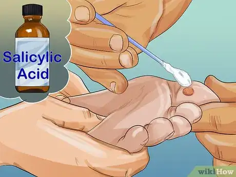 Image titled Pumice a Wart Step 3