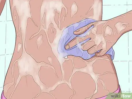 Image titled Treat an Irritated Belly Button Piercing Step 2