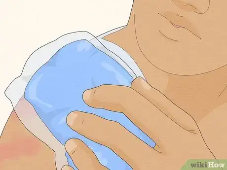 Image titled Recognize Hives (Rash) Step 13