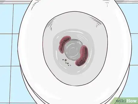 Image titled Stop Rectal Bleeding Step 3