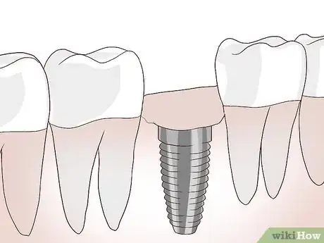 Image titled Know What to Expect when Getting a Tooth Implant Step 12