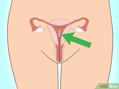 Image titled Deal with Prolonged Menstruation Step 13