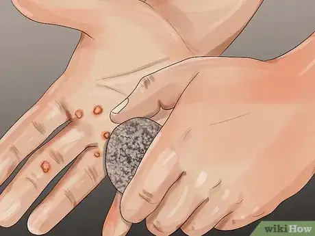 Image titled Pumice a Wart Step 6