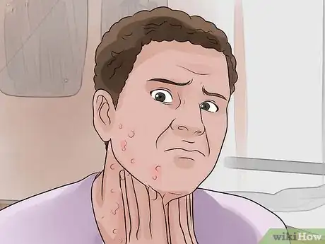 Image titled Recognize and Prevent Rubella (German Measles) Step 1