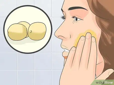 Image titled Treat Cystic Acne Naturally Step 14