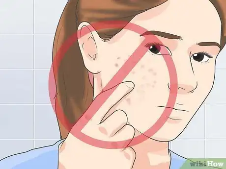 Image titled Treat Cystic Acne Naturally Step 18