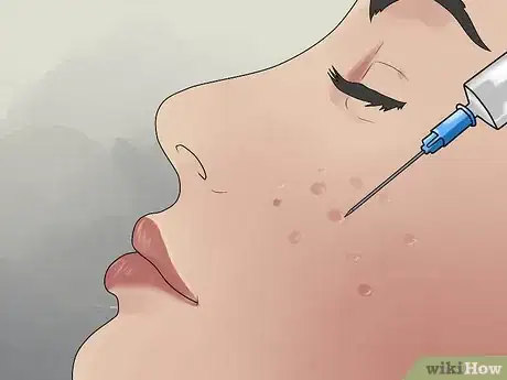 Image titled Get Rid of Cystic Acne Scars Step 10