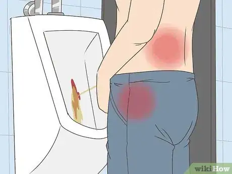 Image titled Treat Bladder Cancer Step 6