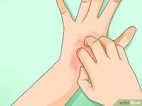 Image titled Know if You Have Sensitive Skin Step 1