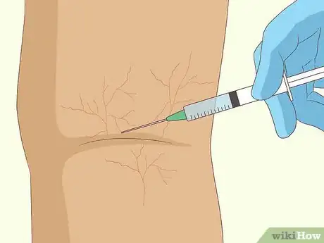 Image titled Remove Spider Veins Step 1